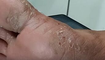 Τύποι και μορφές μυκήτων στα δάχτυλα των ποδιών