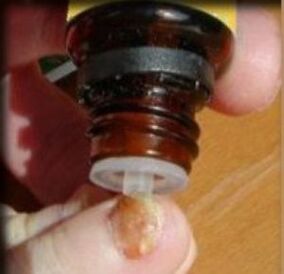 Εφαρμογή σταγόνων σε ένα νύχι που έχει προσβληθεί από μύκητες